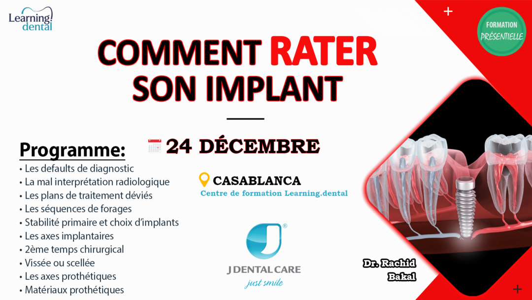 Comment rater son implant
