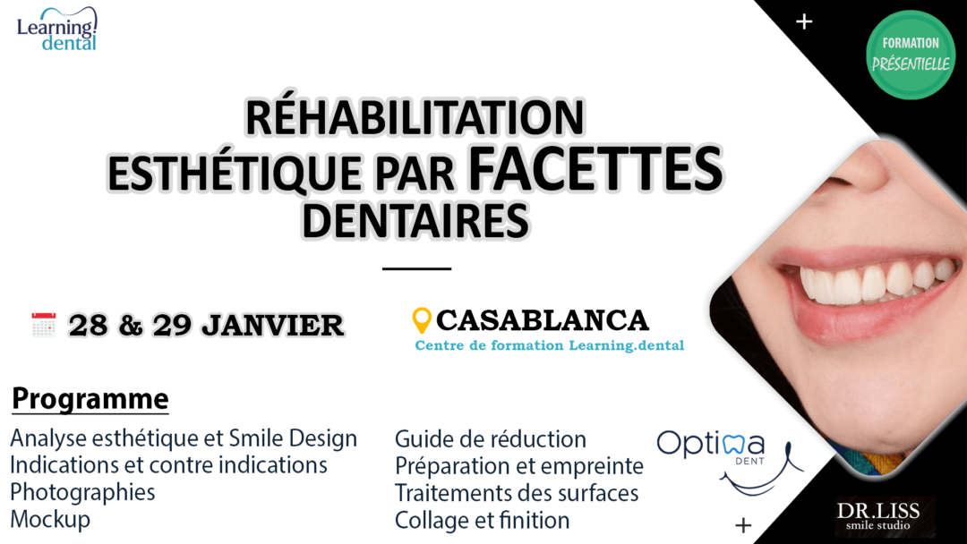 Réhabilitation esthétique par facettes dentaires