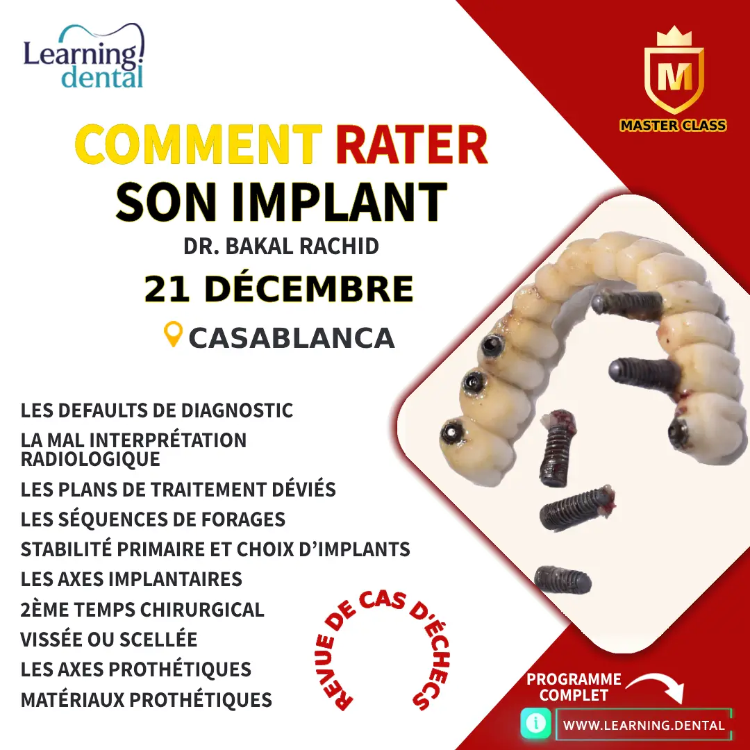 Comment rater son implant