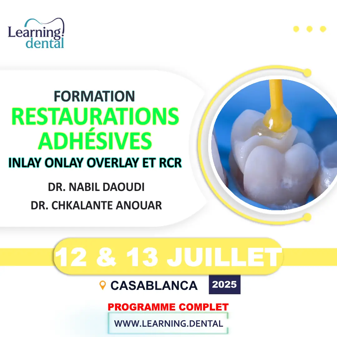 Restaurations Adhésives Inlay onlay overlay et RCR